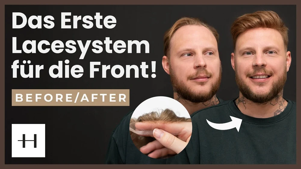 WELTNEUHEIT: Das Erste Lace-Hairlinesystem – So Natürlich war Deine Haarlinie noch Nie!